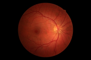 Healthy-retina