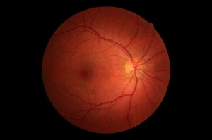 Healthy retina